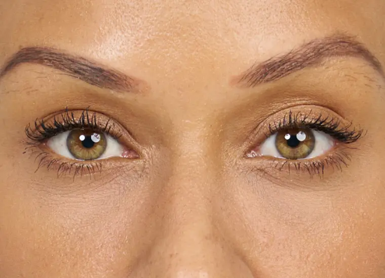 After results with Belotero Balance (+) for infraorbital hollows