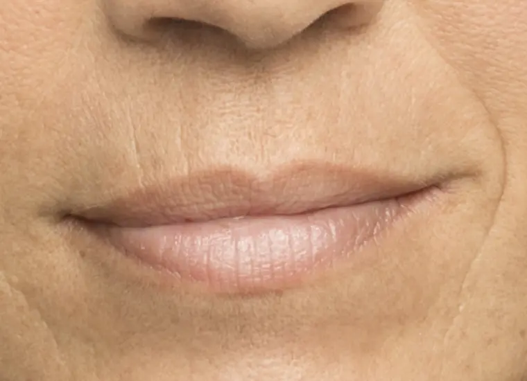 Before results with Belotero Balance (+) for oral commissures