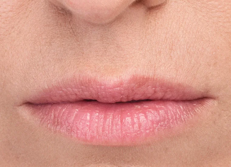 After results with Belotero Balance (+) for perioral lines