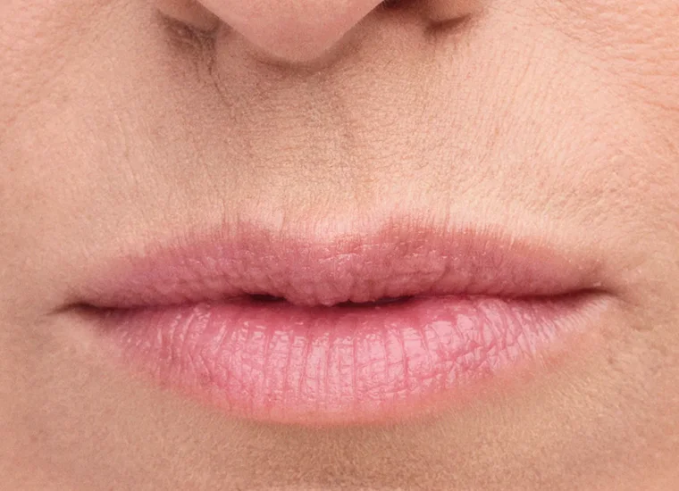 Before results with Belotero Balance (+) for perioral lines